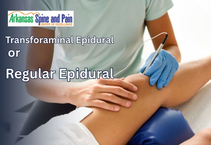 Is Transforaminal Epidural Better Than Regular Epidural?