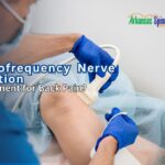 Explore the longevity of RFA for chronic back pain. Learn why relief lasts 6–18 months, how nerves regenerate, and why it’s a top non-surgical alternative.