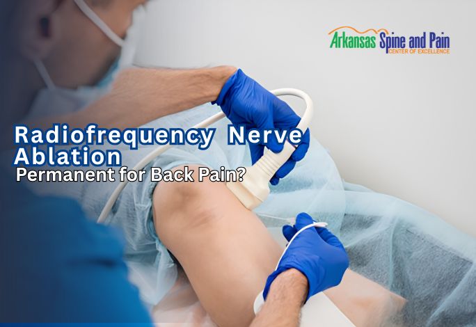 Explore the longevity of RFA for chronic back pain. Learn why relief lasts 6–18 months, how nerves regenerate, and why it’s a top non-surgical alternative.