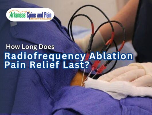 Most patients enjoy 6 to 18 months of relief with Radiofrequency Ablation. Learn why RFA lasts longer than injections and what to expect during recovery.