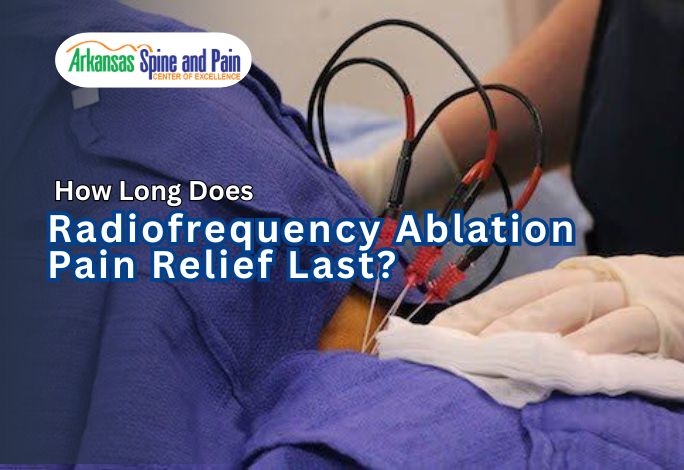 Most patients enjoy 6 to 18 months of relief with Radiofrequency Ablation. Learn why RFA lasts longer than injections and what to expect during recovery.