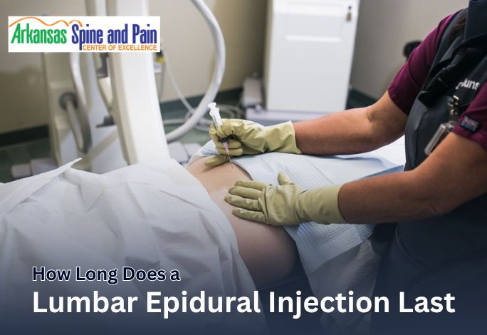 How Long Does a Lumbar Epidural Injection Last?