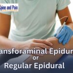 Is Transforaminal Epidural Better Than Regular Epidural?