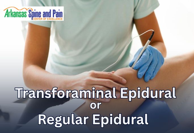 Is Transforaminal Epidural Better Than Regular Epidural?