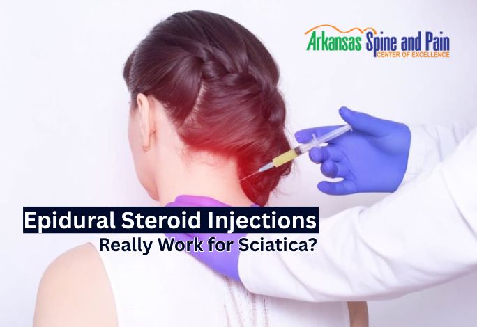 Do Epidural Steroid Injections Really Work for Sciatica?