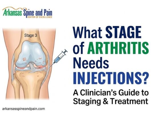 What Stage of Arthritis Needs Injections? Clinical Guide