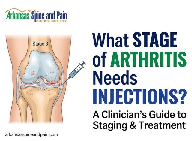 What Stage of Arthritis Needs Injections? Clinical Guide