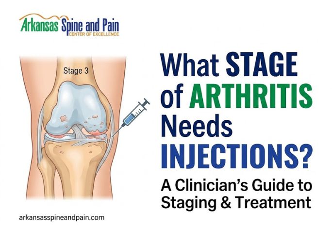 What Stage of Arthritis Needs Injections? Clinical Guide